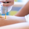 laser hair removal leigh on sea essex