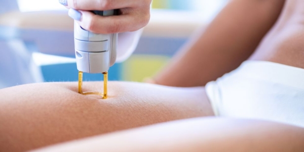 laser hair removal leigh on sea essex